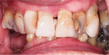 Periodontal Surgery